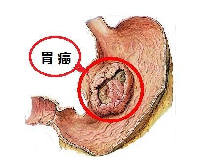 咽喉下垂一个月，症状、原因与治疗方法